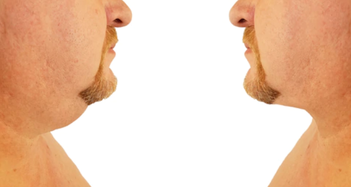 A Chin Liposuction in Korea: Quick Facts You Should Know to Achieve a Refined Chin 