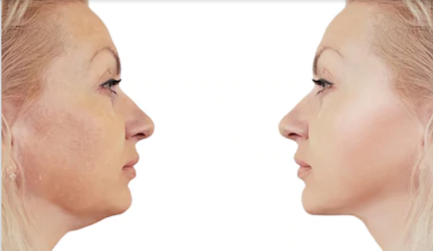 A Chin Liposuction in Korea: Quick Facts You Should Know to Achieve a Refined Chin 
