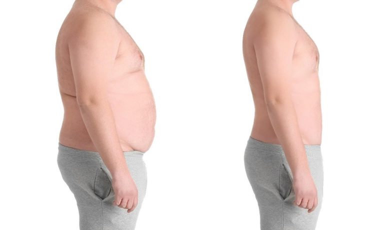 extended tummy tuck recovery