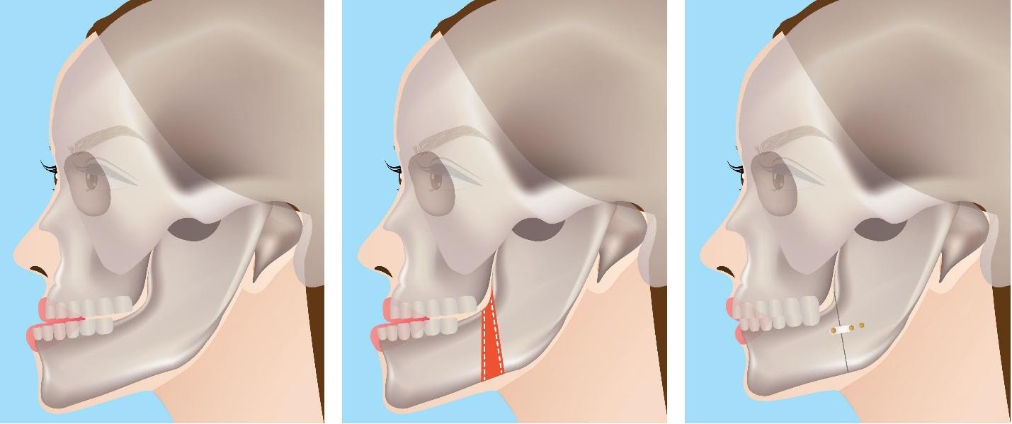 lower jaw neck diagrams