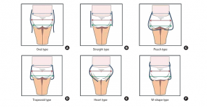 Things To Know Before Getting A Fat Transfer To The Hips - CLINICLO
